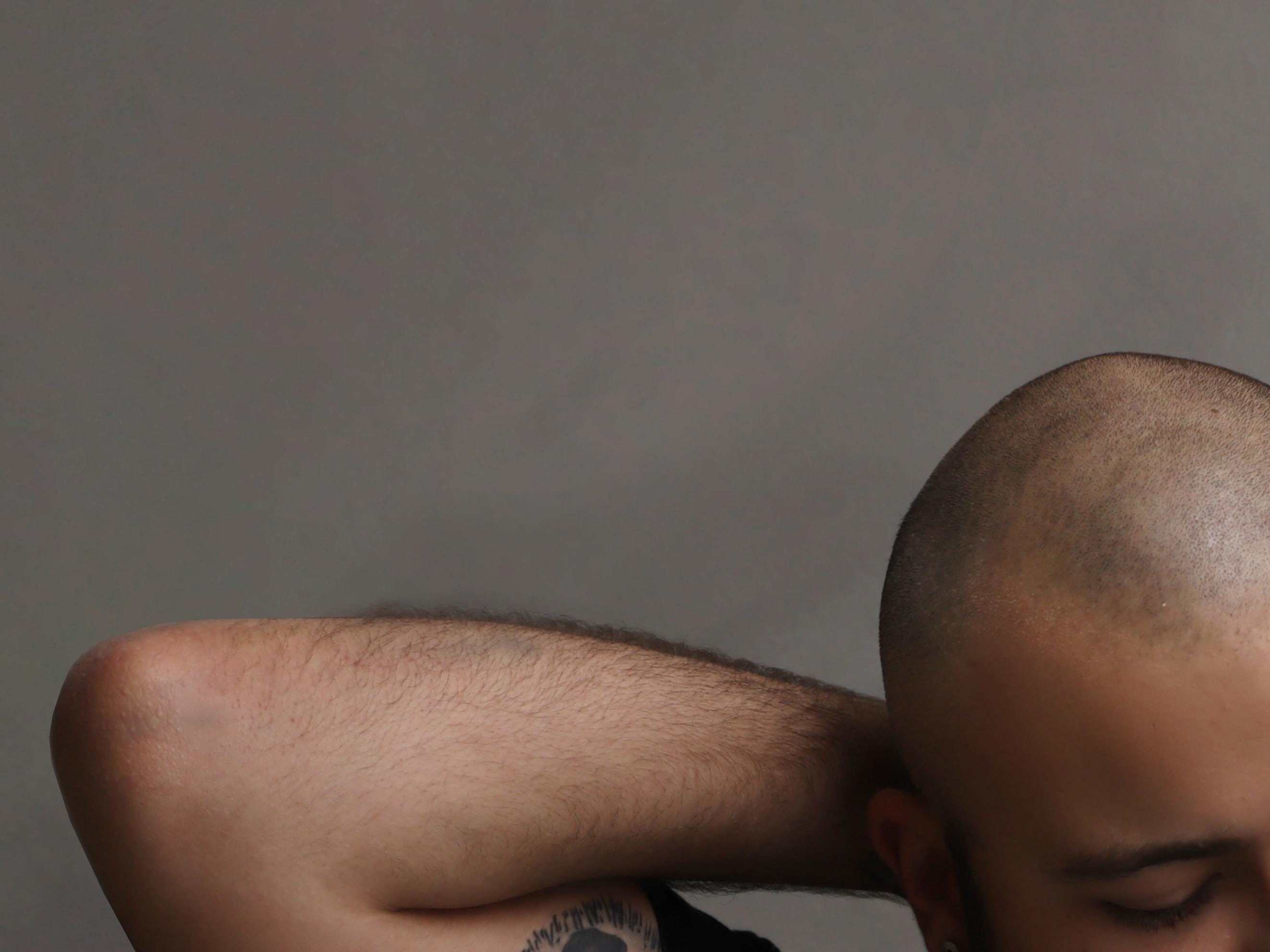 Entenda como funciona o transplante capilar